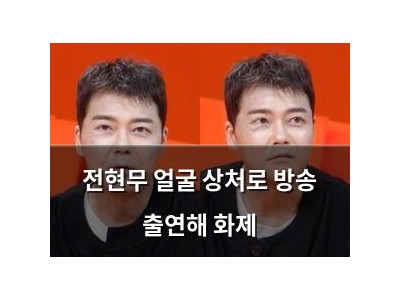 전현무 얼굴 상처로 방송 출연해 화제
